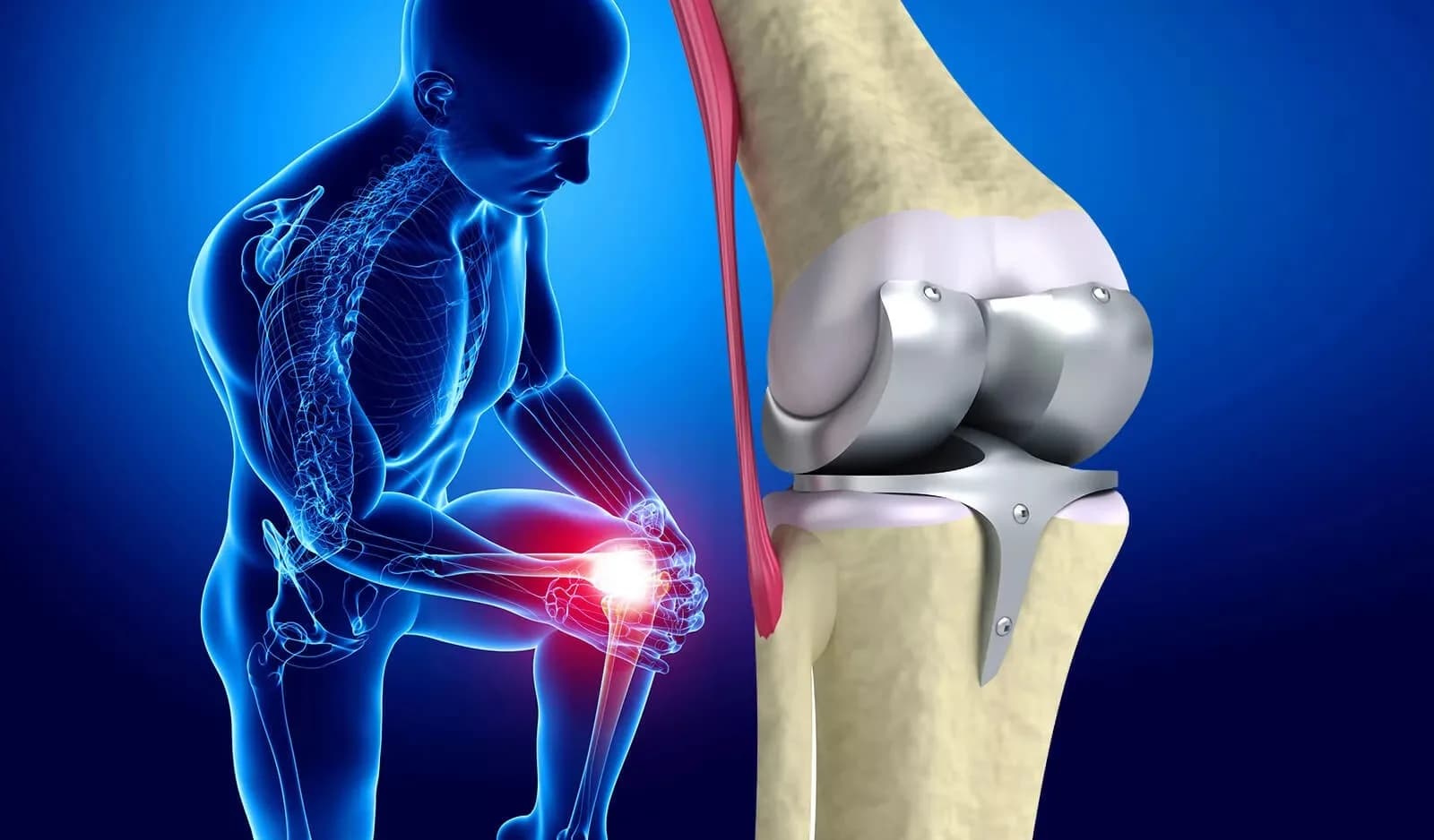 Diz oynağının kalsifikasiyası (diz osteoartriti)