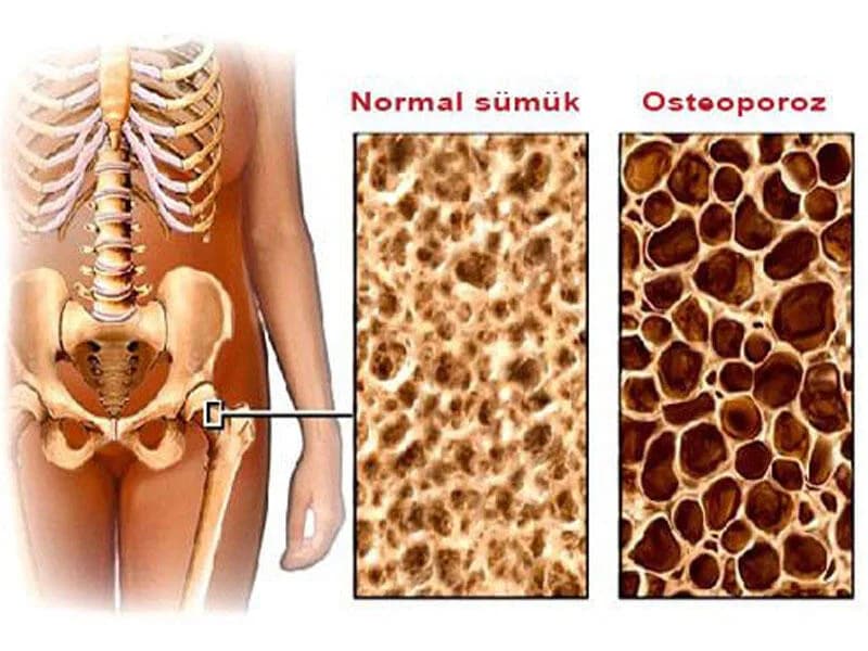 OSTEOPOROZ NƏDİR?