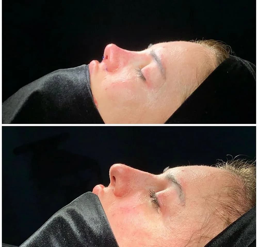 Rinoplastika nə zaman edilir?
