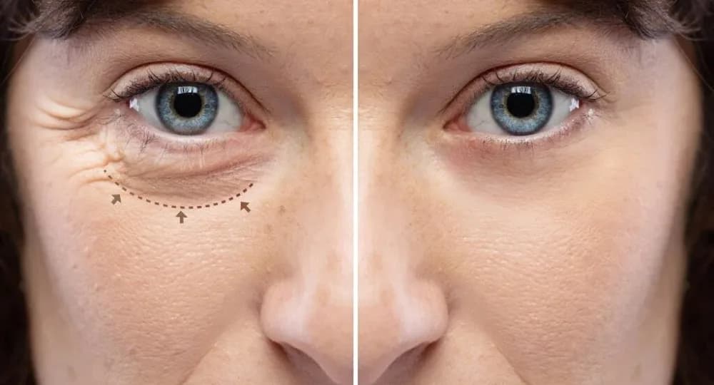 Blefaroplastika