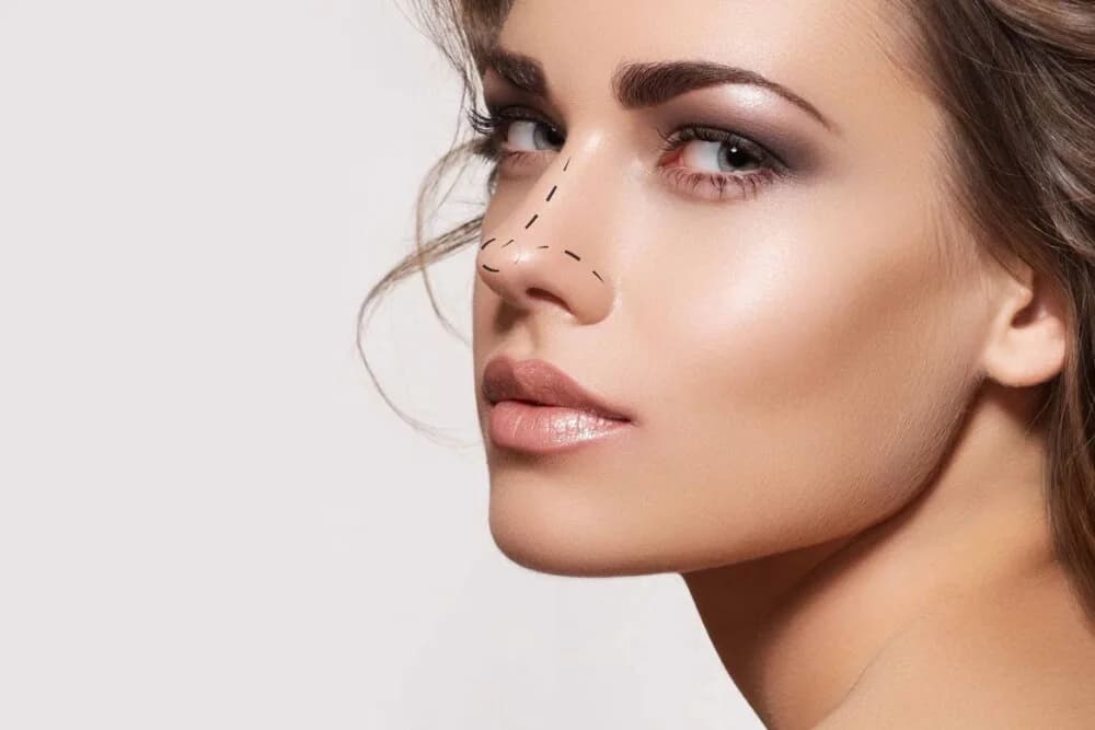 Rinoplastika haqqında bütün məlumatlar