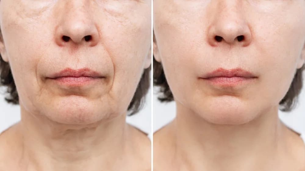Facelift əməliyyatı