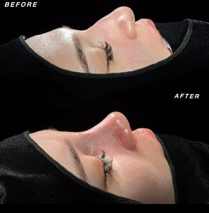 Septum deviayasiyası