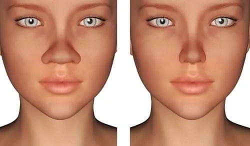 Rinoplastika