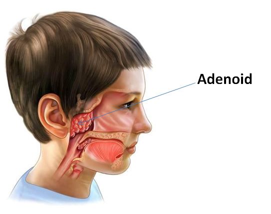 Uşaqlarda Adenoid Problemi